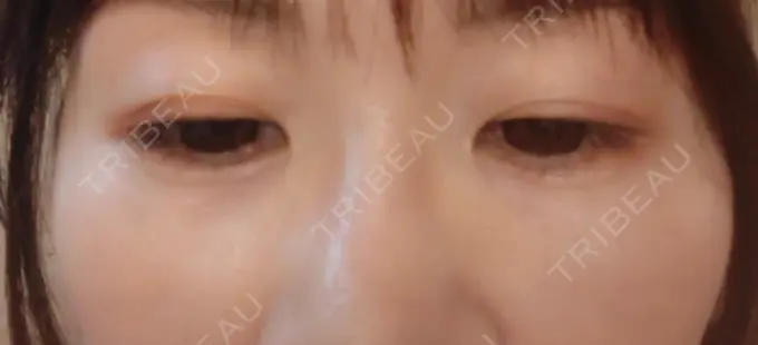 ヒアルロン酸注入（目の下） SOL CLINIC DAY 4 メイン用