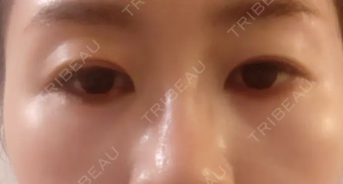 ヒアルロン酸注入（目の下） SOL CLINIC AFTER メイン用