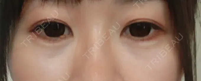 ヒアルロン酸注入（目の下） SOL CLINIC DAY 8 メイン用