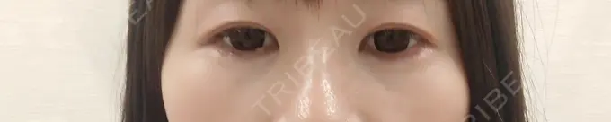 ヒアルロン酸注入（目の下） SOL CLINIC DAY 5 メイン用