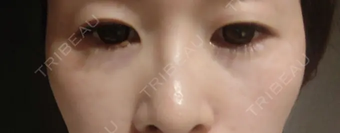 ヒアルロン酸注入（目の下） SOL CLINIC DAY 6 メイン用