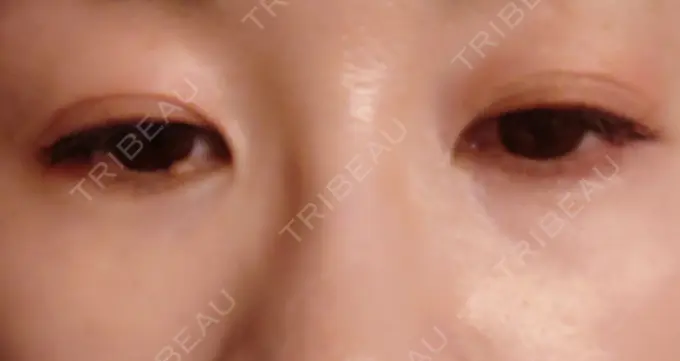 ヒアルロン酸注入（目の下） SOL CLINIC DAY 7 メイン用