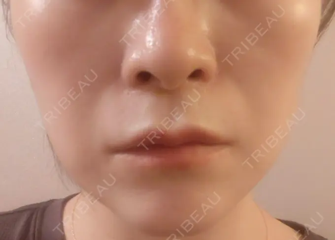 ボトックス（エラ・小顔） 新宿TAクリニック DAY 6 メイン用