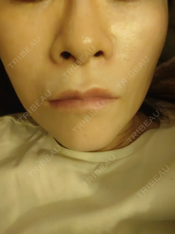 ボトックス（エラ・小顔） 新宿TAクリニック DAY 7 メイン用