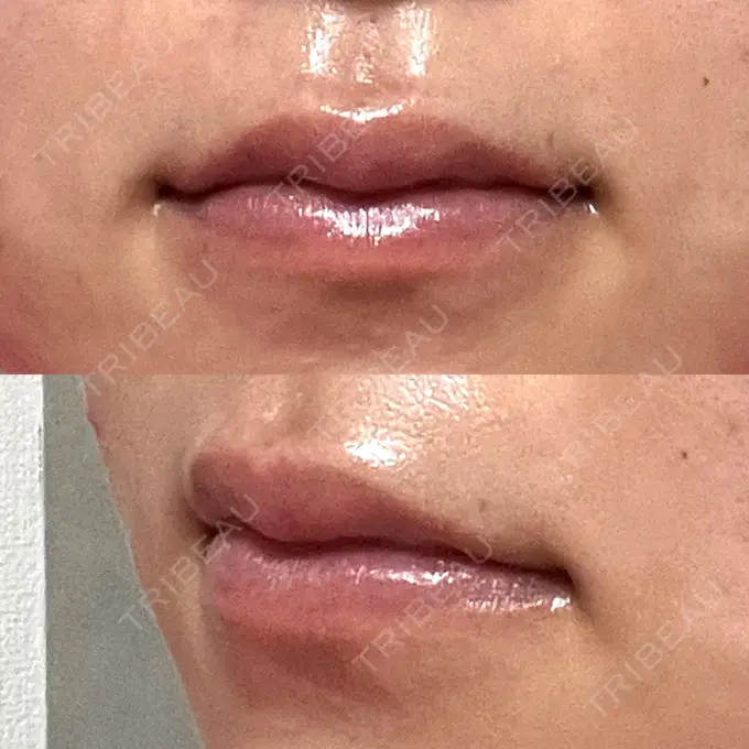 ヒアルロン酸注入（唇） 大美会クリニック 神戸院 DAY 5 メイン用
