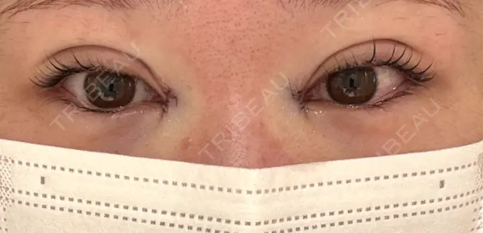 二重埋没 / 目頭切開 eクリニック 福岡院 DAY 0 メイン用