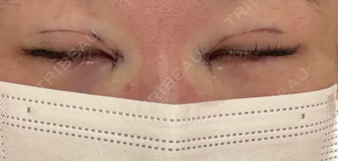 二重埋没 / 目頭切開 eクリニック 福岡院 DAY 0 メイン用