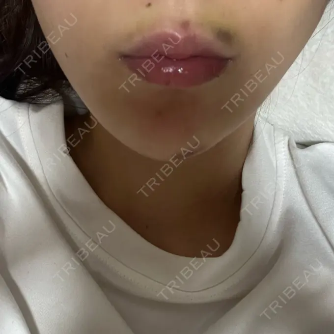 糸リフト アリエル美容クリニック 横浜院 DAY 6 メイン用