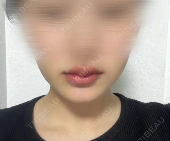 ヒアルロン酸注入（唇） アリエル美容クリニック 横浜院 DAY 1 メイン用