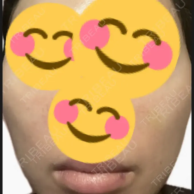 プラセンタ注射 / その他（肌） 美容皮膚科エルムクリニック 麻布院 DAY 1 メイン用