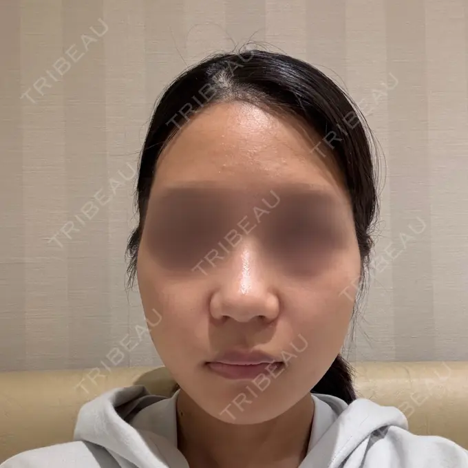 肌育注射（ジュベルックなど） TRUE DESIGN CLINIC AFTER メイン用