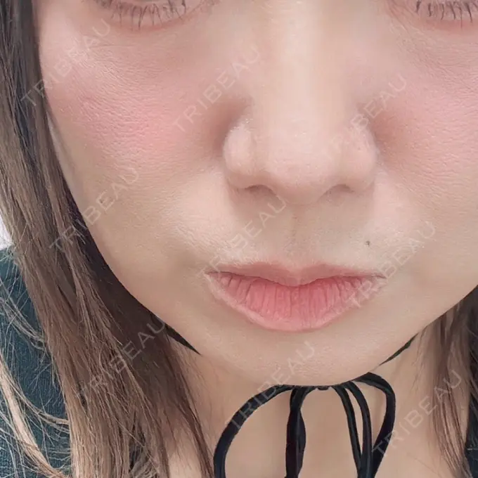 ボトックス（エラ・小顔） ビューティー和心クリニック 浅草院 DAY 0 メイン用