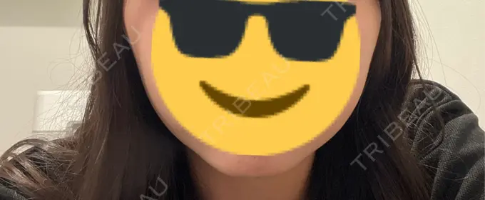 ボトックス（エラ・小顔） 共立美容外科 立川院 AFTER メイン用