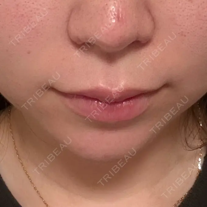 ヒアルロン酸注入（あご） ルラ美容クリニック 渋谷本院 DAY 7 メイン用