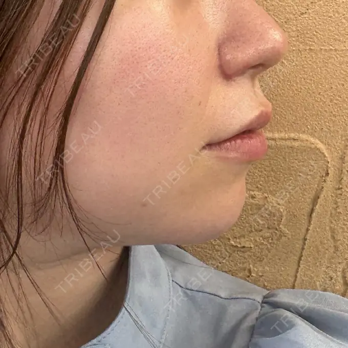 ヒアルロン酸注入（あご） ルラ美容クリニック 渋谷本院 DAY 12 メイン用