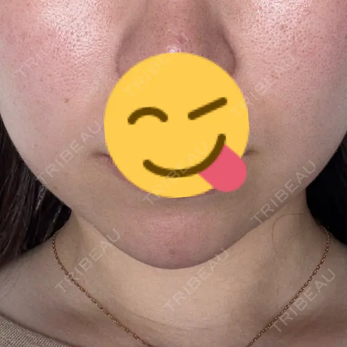 ヒアルロン酸注入（あご） ルラ美容クリニック 渋谷本院 DAY 27 メイン用