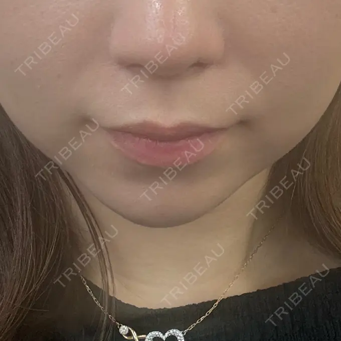 ヒアルロン酸注入（あご） ルラ美容クリニック 渋谷本院 DAY 44 メイン用