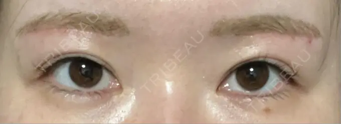 眉下切開 / ボトックス（眉間） / ボトックス（額） 銀座リシェスクリニック DAY 91 メイン用