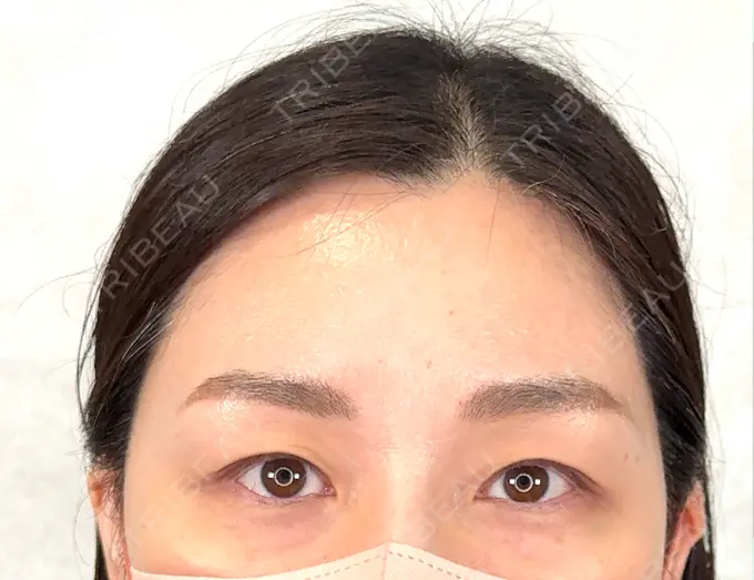 ヒアルロン酸注入（唇） / ヒアルロン酸注入（目の下） アリエル美容クリニック 横浜院 DAY 0 メイン用