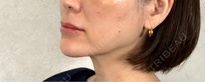 ヒアルロン酸注入（唇） / ヒアルロン酸注入（目の下） アリエル美容クリニック 横浜院 DAY 0 メイン用