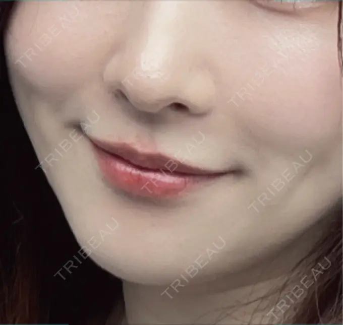 糸リフト / 脂肪吸引（顔） / 脂肪吸引注射（顔） / ヒアルロン酸注入（頬） ziz CLINIC AFTER メイン用