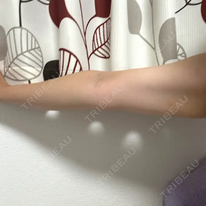 脂肪溶解注射（二の腕） 東京秘密クリニック 渋谷院 DAY 3 メイン用