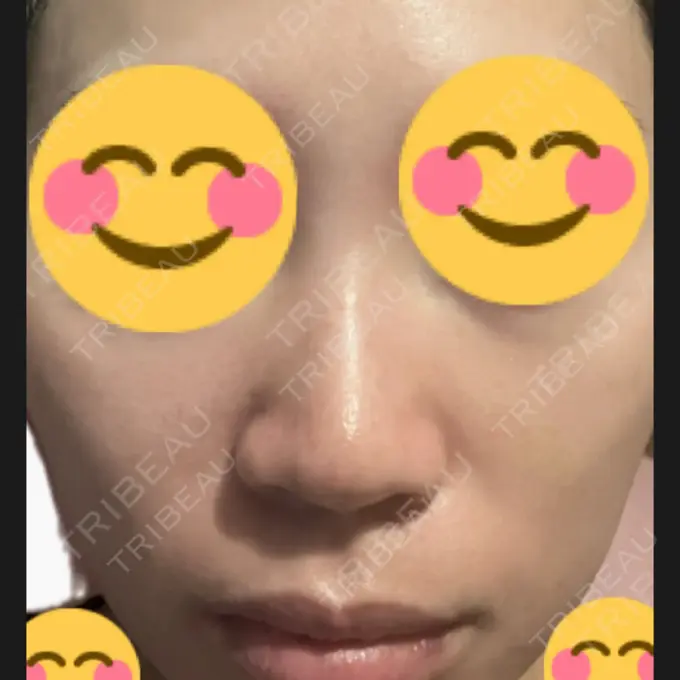 プラセンタ注射 / その他（肌） 美容皮膚科エルムクリニック 麻布院 DAY 2 メイン用