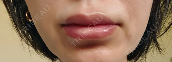 ヒアルロン酸注入（唇） / ヒアルロン酸注入（目の下） アリエル美容クリニック 横浜院 DAY 1 メイン用