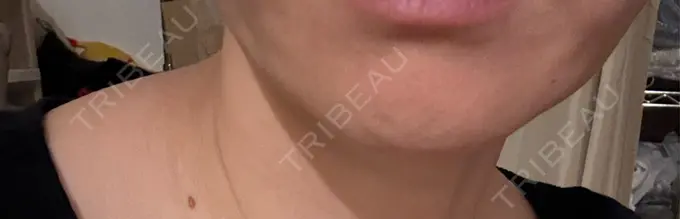 シワ取りボトックス AB美容クリニック 新宿院 DAY 12 メイン用