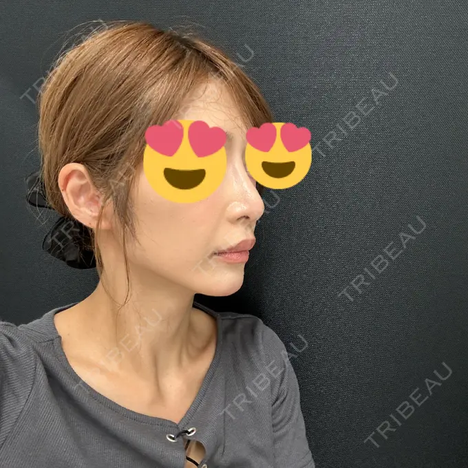 軟骨移植 / 眉間プロテーゼ / 鼻尖縮小 / ヒアルロン酸注入（鼻翼基部） 東京シンデレラ美容外科 新宿院 DAY 90 メイン用