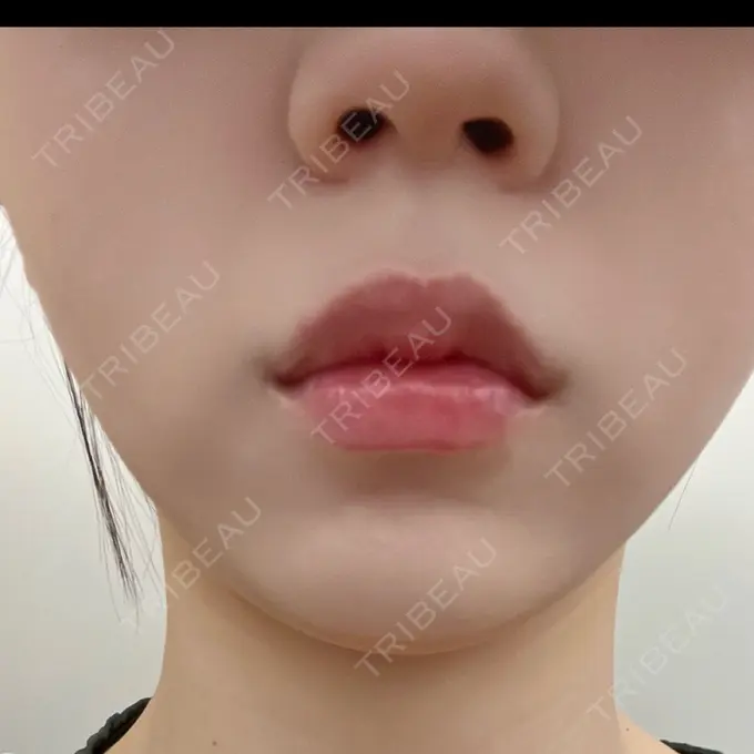 ルメッカ plume clinic AFTER メイン用