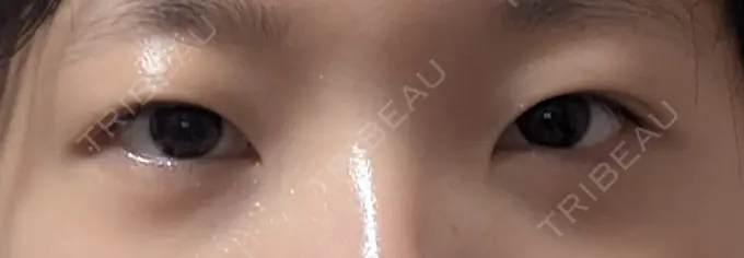 下まぶたの脂肪取り 表参道ウィズ・クリニック AFTER メイン用