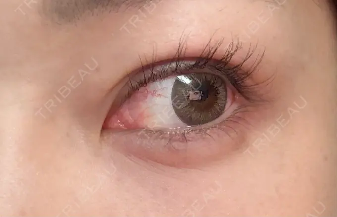 ヒアルロン酸注入（涙袋） 新宿TAクリニック DAY 4 メイン用