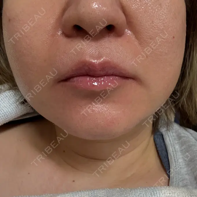 ボトックス（エラ・小顔） フィラークリニック 大阪梅田院 AFTER メイン用