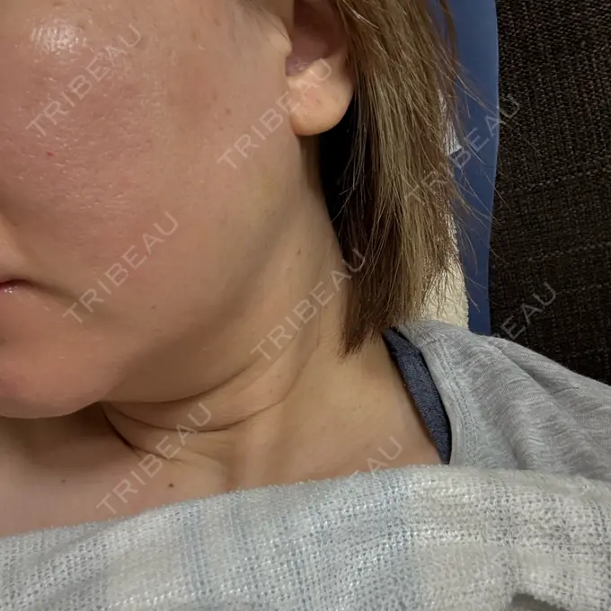 ボトックス（エラ・小顔） フィラークリニック 大阪梅田院 DAY 6 メイン用