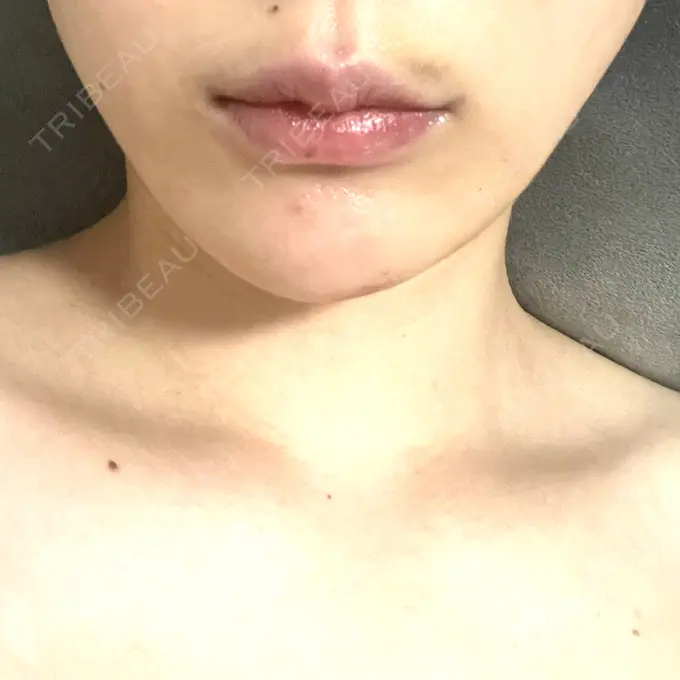 糸リフト アリエル美容クリニック 横浜院 DAY 7 メイン用