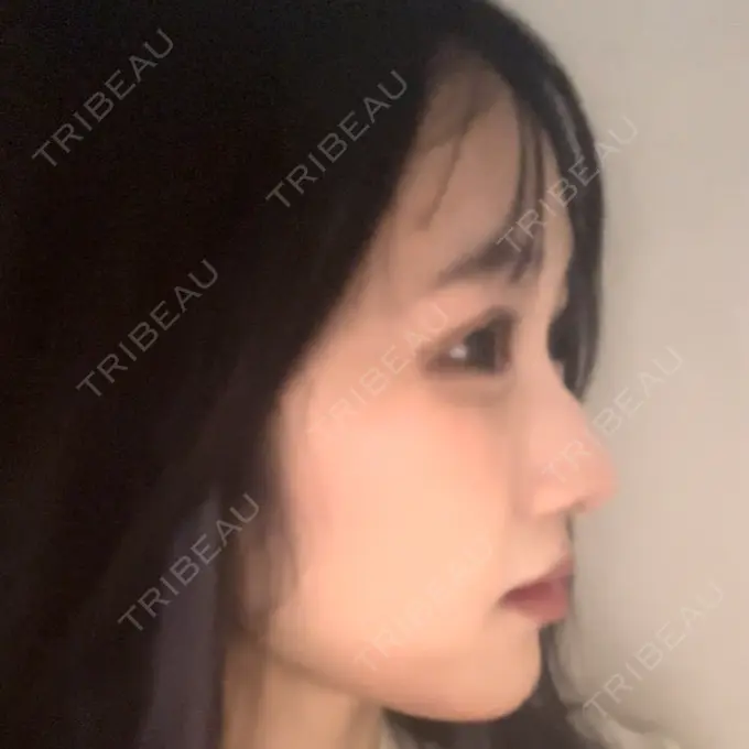 ヒアルロン酸注入（あご） / ヒアルロン酸注入（頬） SUNMELIA SKIN CLINIC AFTER メイン用