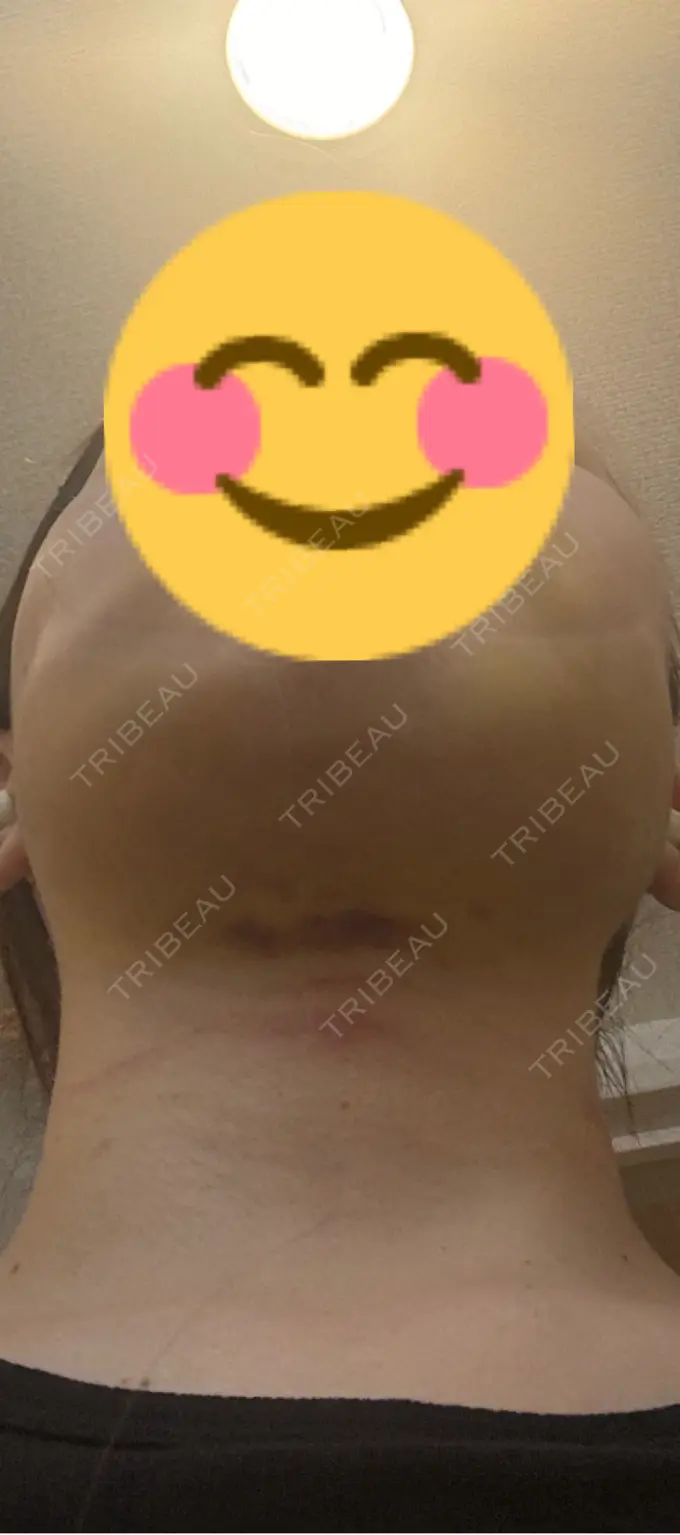 糸リフト / バッカルファット除去 / 脂肪吸引（顔） アリエル美容クリニック 横浜院 DAY 4 メイン用