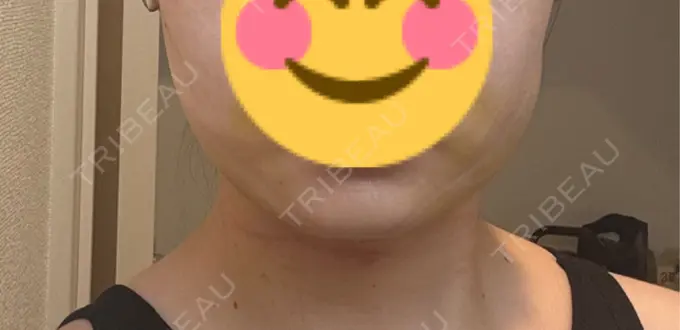 糸リフト / バッカルファット除去 / 脂肪吸引（顔） アリエル美容クリニック 横浜院 DAY 4 メイン用