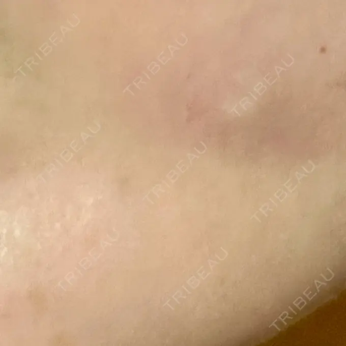 糸リフト / 脂肪吸引（顔） / ジョールファット除去 / 脂肪吸引注射（顔） ziz CLINIC DAY 15 メイン用