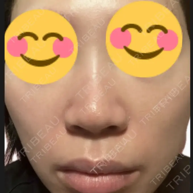 プラセンタ注射 / その他（肌） 美容皮膚科エルムクリニック 麻布院 DAY 3 メイン用