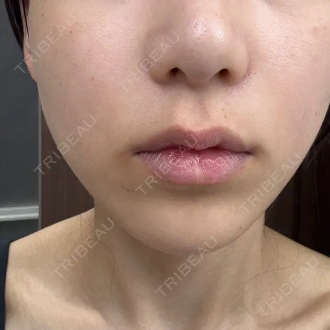 ルメッカ さっぽろ美容クリニック DAY 5 メイン用