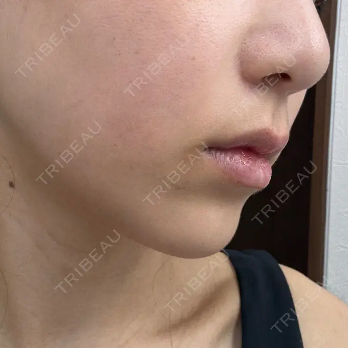 ルメッカ さっぽろ美容クリニック DAY 5 メイン用