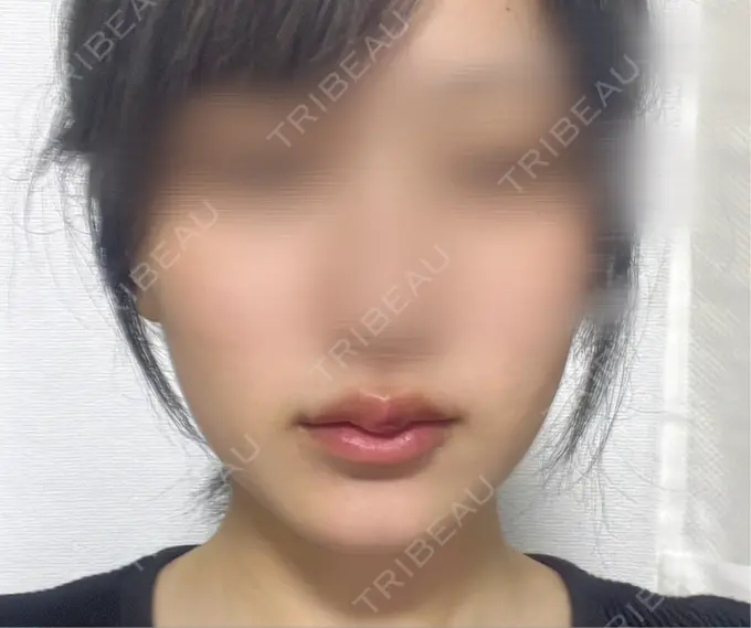 ヒアルロン酸注入（唇） アリエル美容クリニック 横浜院 DAY 2 メイン用