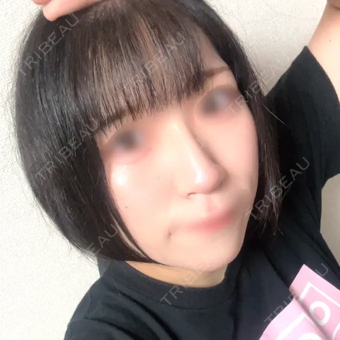 医療脱毛（顔） Sea Sail Beauty Clinic AFTER メイン用