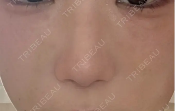 骨切幅寄せ 札幌ル・トロワ ビューティクリニックVogue AFTER メイン用