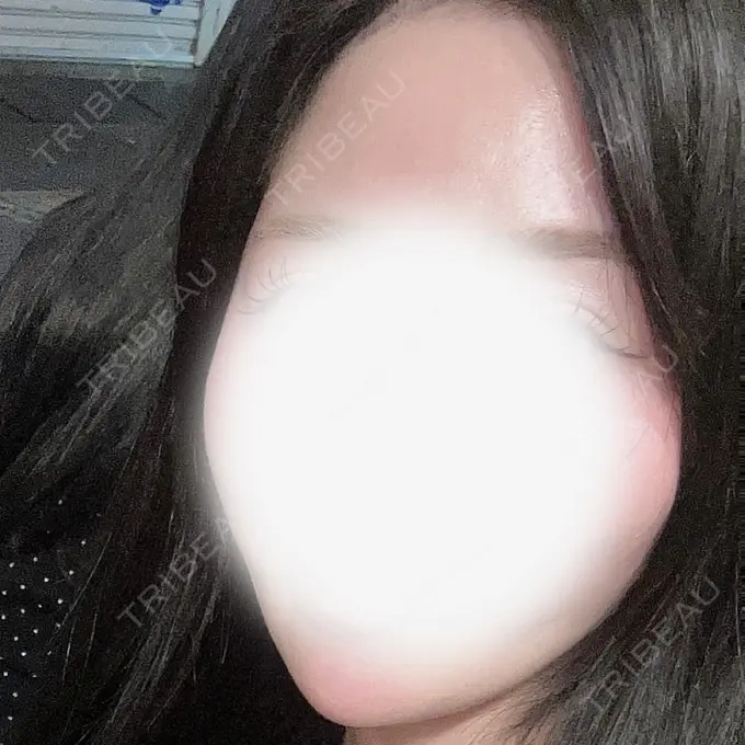 ハイフ（顔） ミニマムスキンクリニック池袋 AFTER メイン用