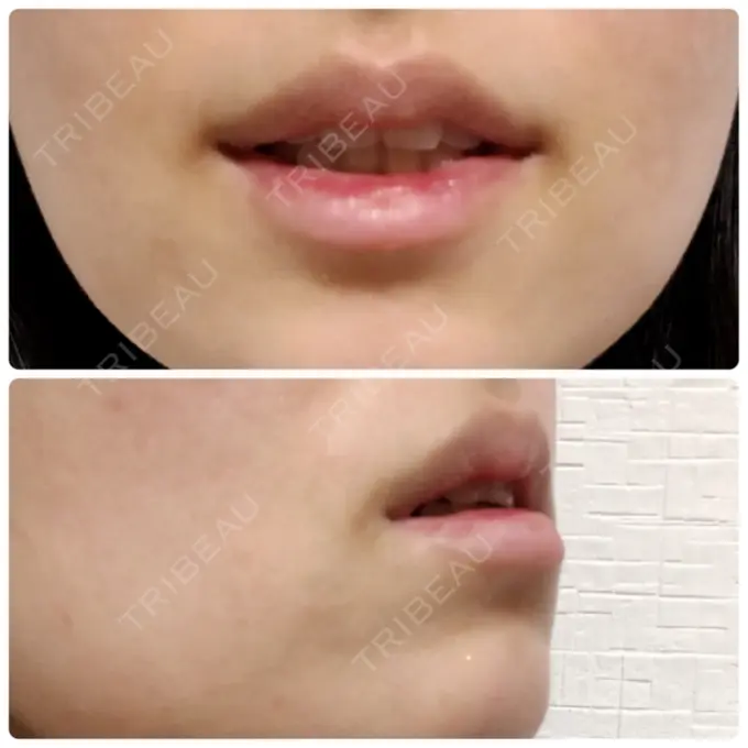 口唇縮小術 品川スキンクリニック表参道院 DAY 30 メイン用
