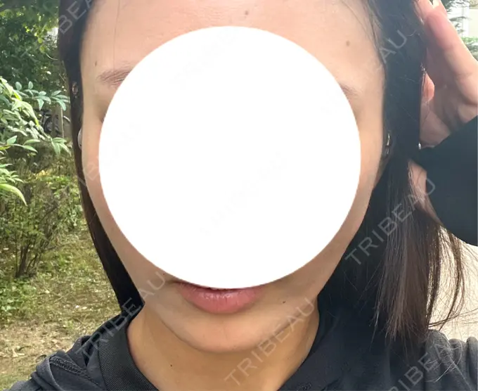 糸リフト / その他（肌） MAクリニック 心斎橋 DAY 2 メイン用