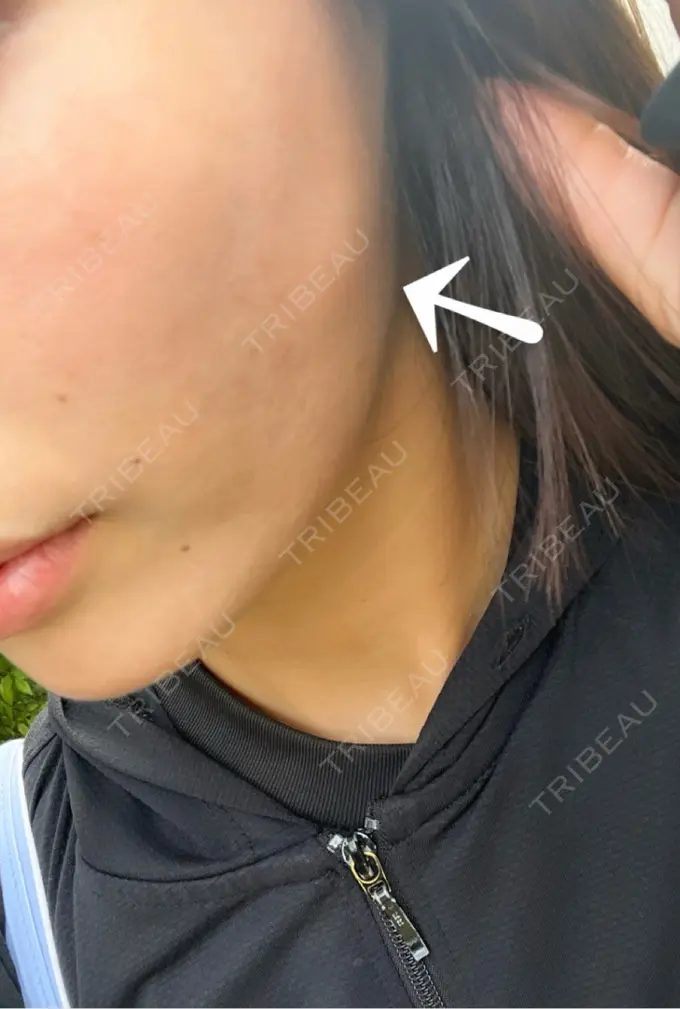 糸リフト / その他（肌） MAクリニック 心斎橋 DAY 2 メイン用